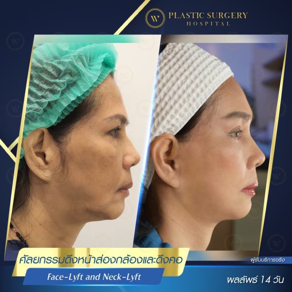 ดึงหน้า