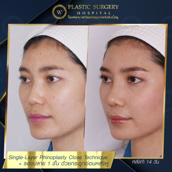 เสริมจมูก