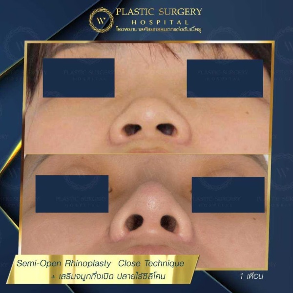 เสริมจมูก