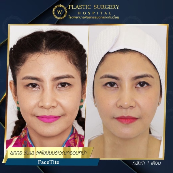 ดูดไขมันเหนียงใต้คาง (FaceTite)