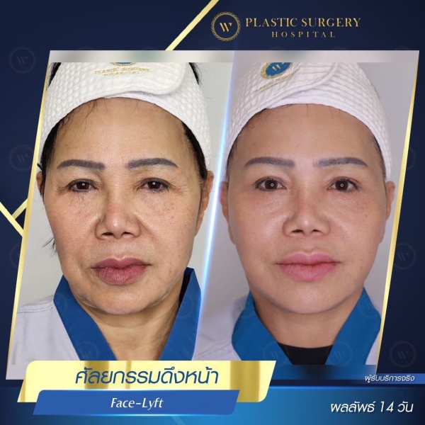 ดึงหน้า