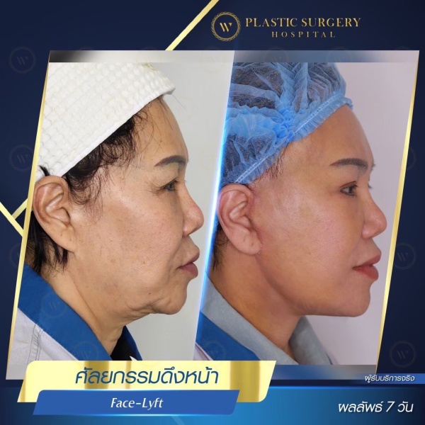 ดึงหน้า