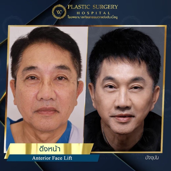 ดึงหน้า