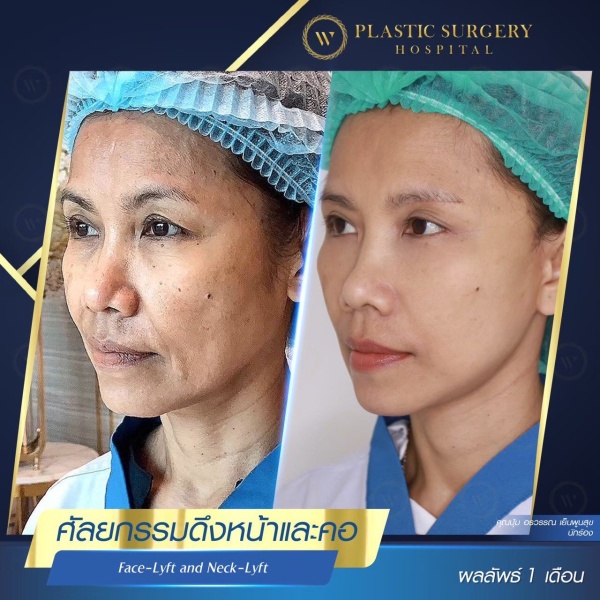 ดึงหน้า