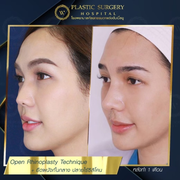 เสริมจมูก