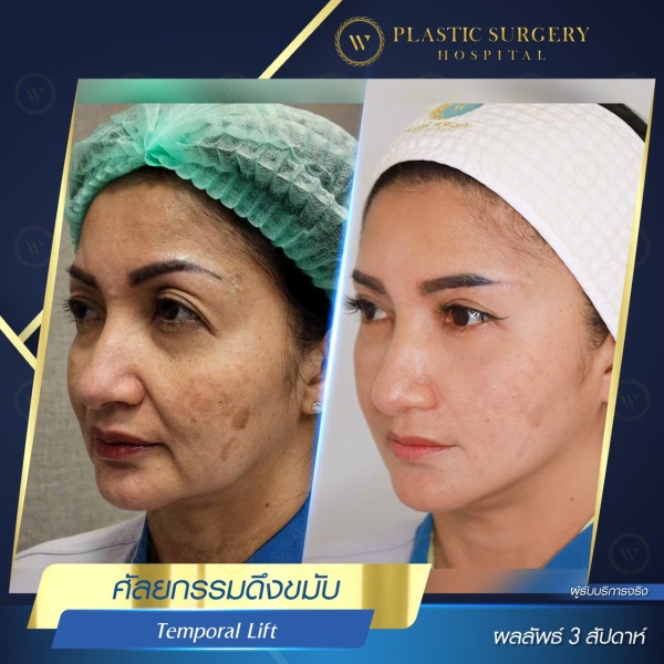 ดึงหน้า