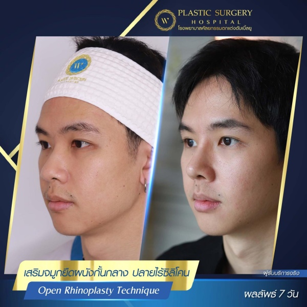 เสริมจมูก