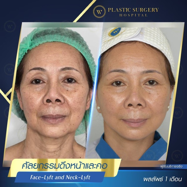 ดึงหน้า