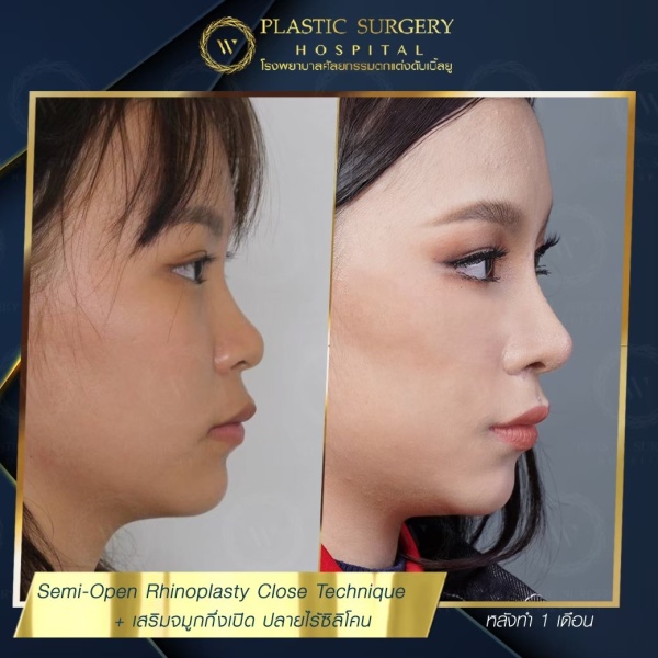 เสริมจมูก