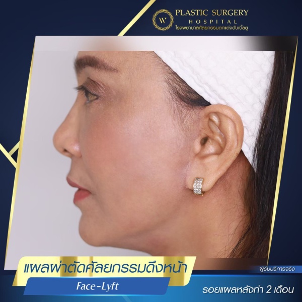 ดึงหน้า