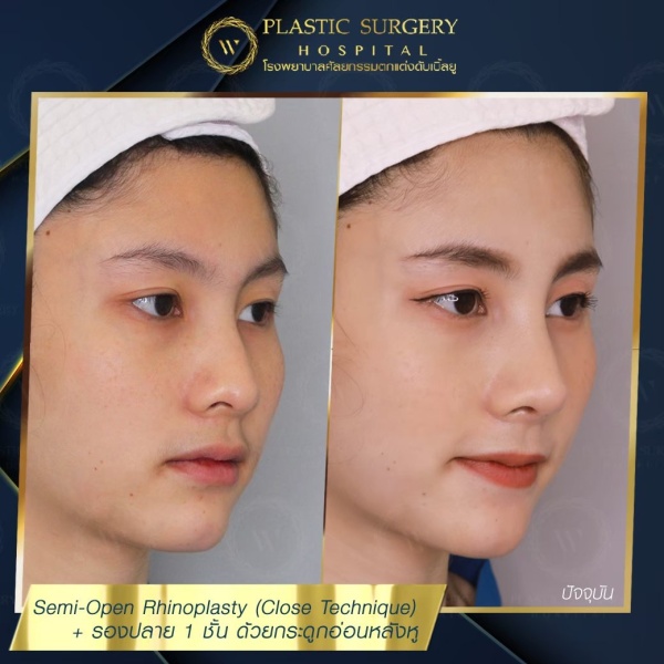 เสริมจมูก