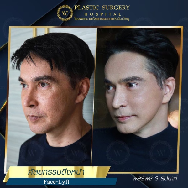 ดึงหน้า