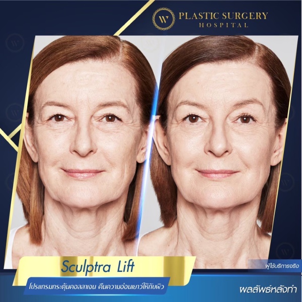 Sculptra Lift