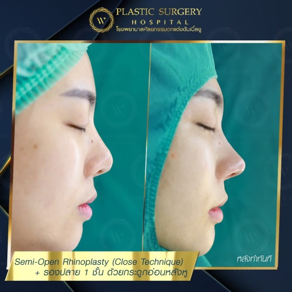 เสริมจมูก