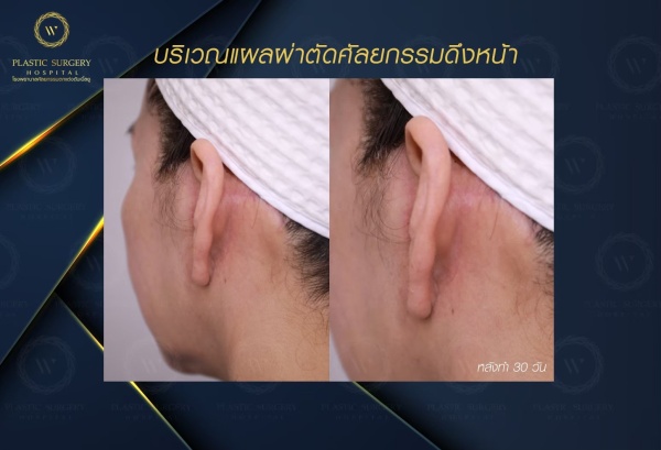 ดึงหน้า