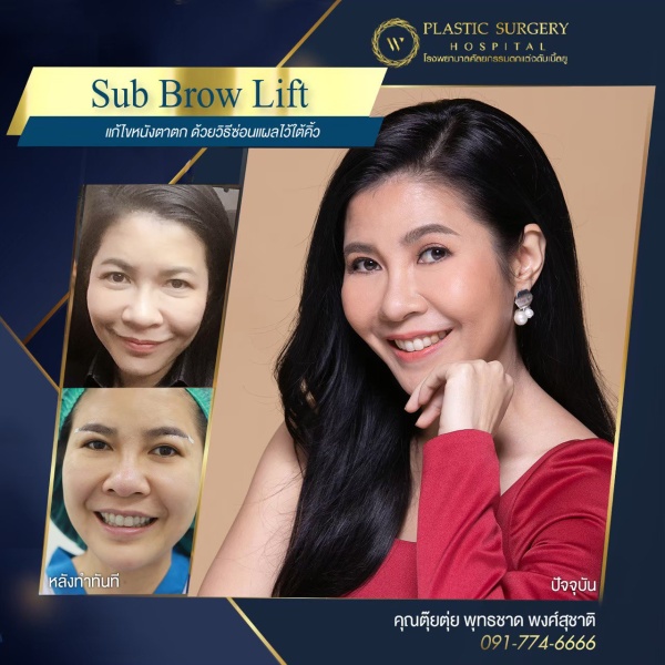 หนังตา/หางตาบนตก