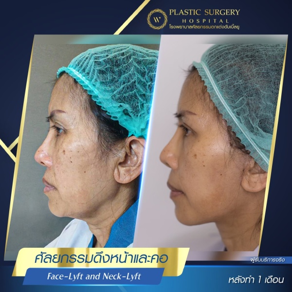 ดึงหน้า