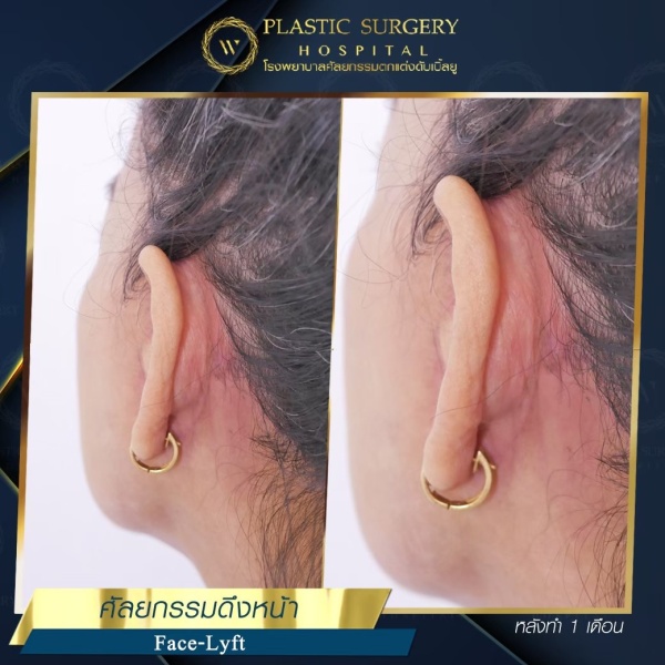 ดึงหน้า