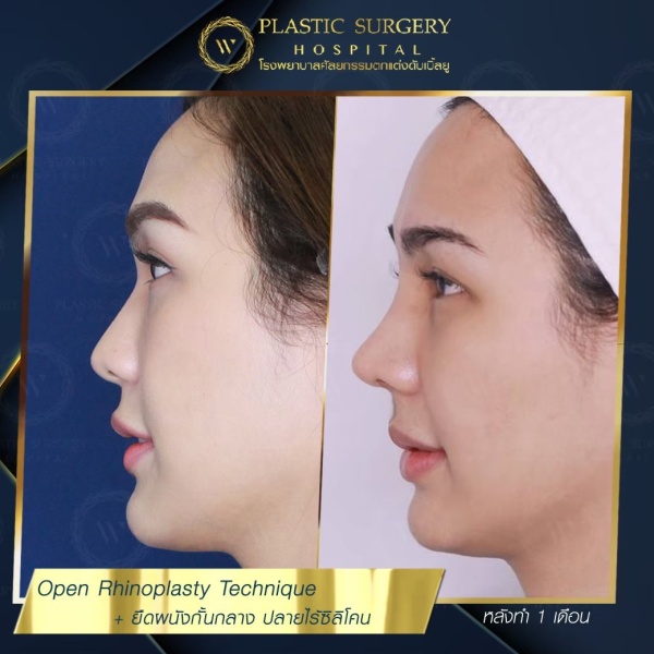 เสริมจมูก