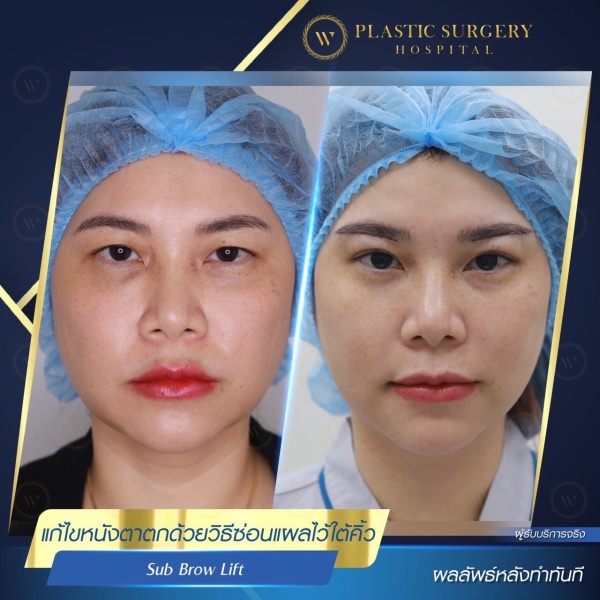 ศัลยกรรมแก้ไขปัญหาหนังตา