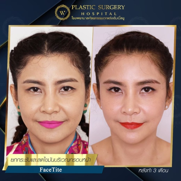 ดูดไขมันเหนียงใต้คาง (FaceTite)