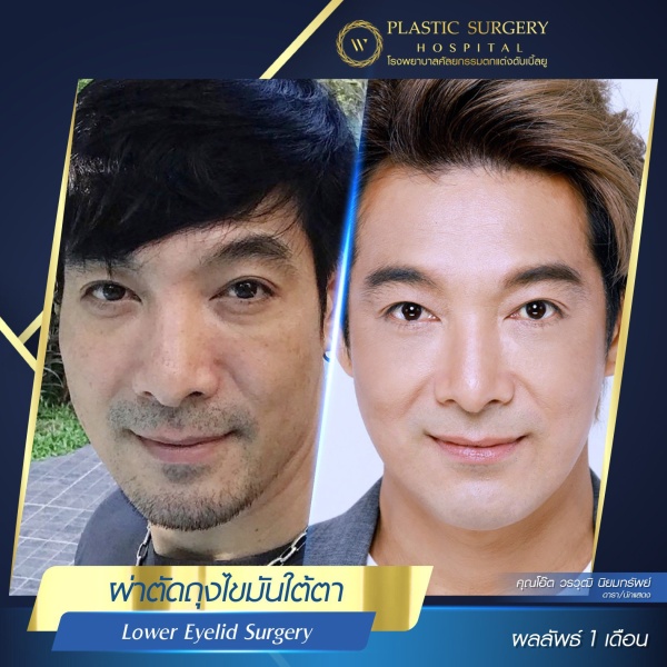 Lower Eyelid Surgery