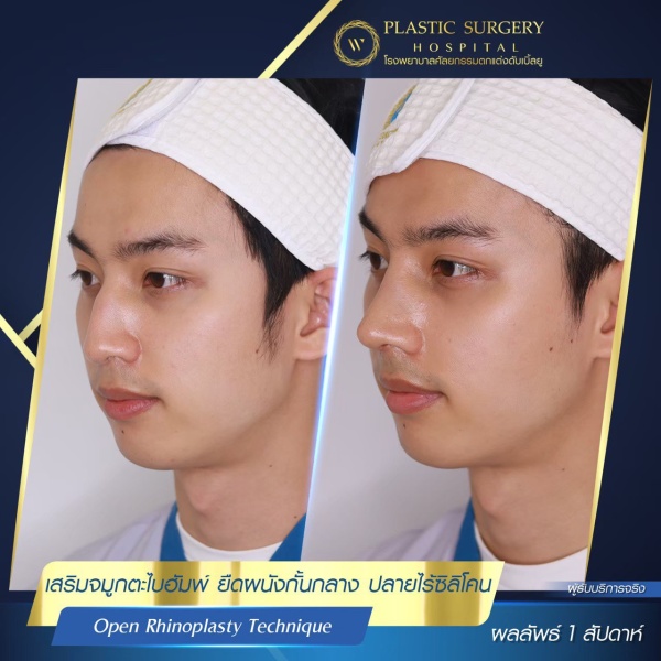 เสริมจมูก