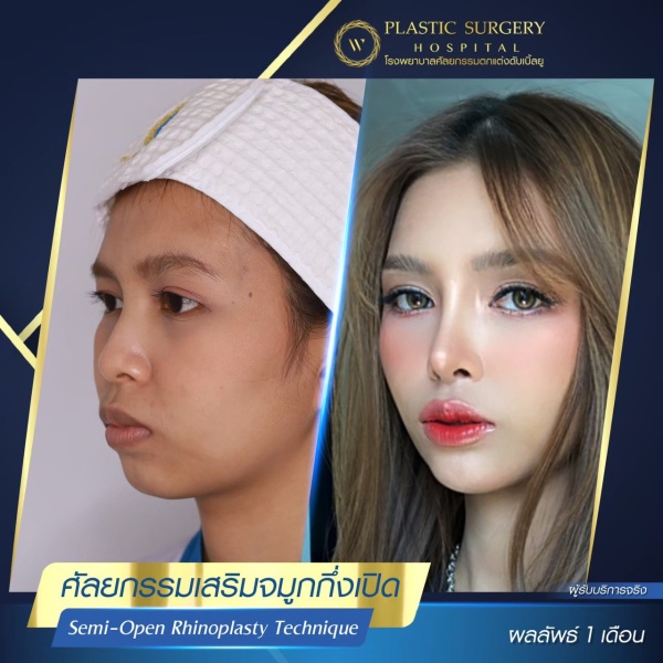 เสริมจมูก