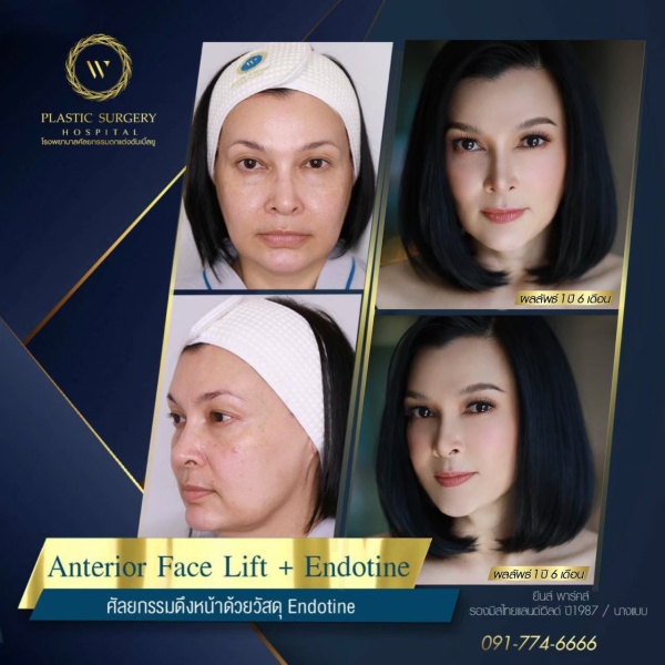 ดึงหน้า