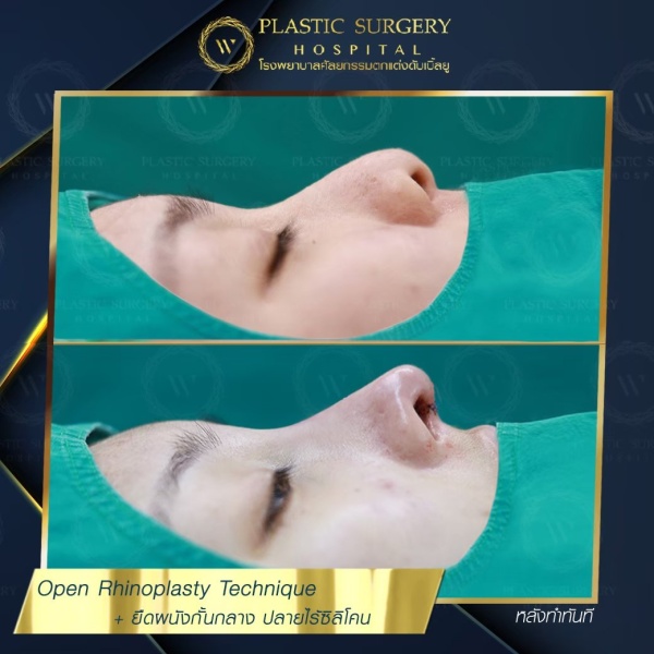 เสริมจมูก