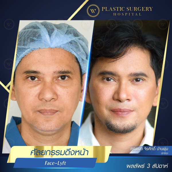 ดึงหน้า