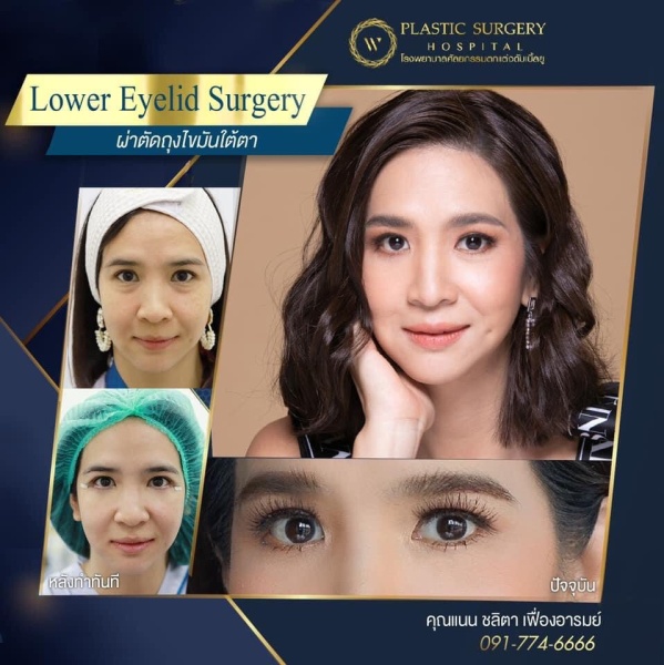 ตัดถุงไขมันใต้ตา