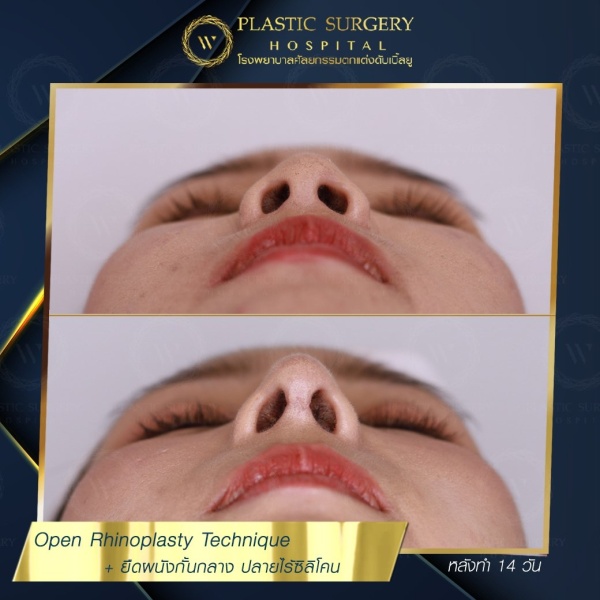 เสริมจมูก