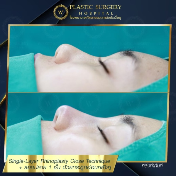 เสริมจมูก