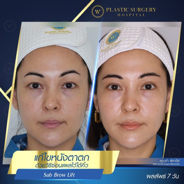 หนังตา/หางตาบนตก