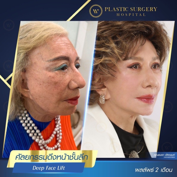 ดึงหน้า