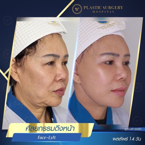 ดึงหน้า