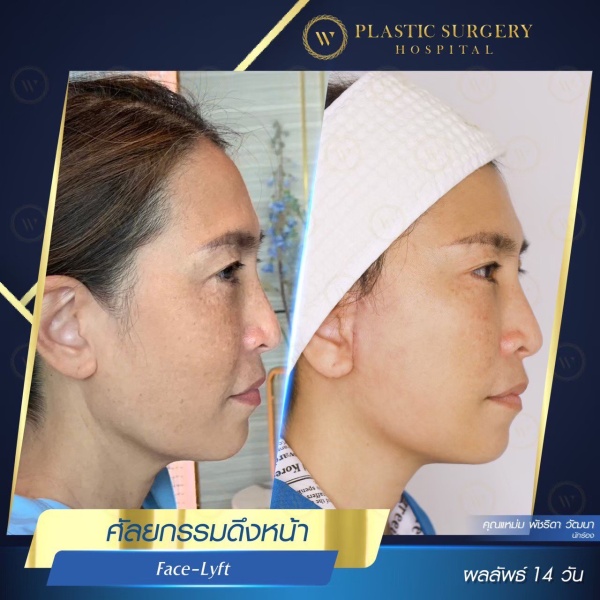 ดึงหน้า