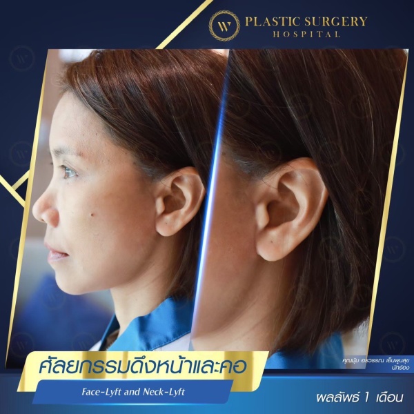 ดึงหน้า