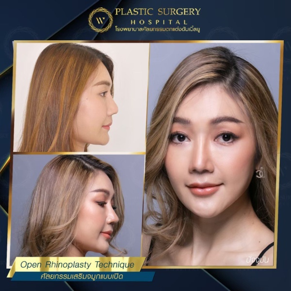 เสริมจมูก