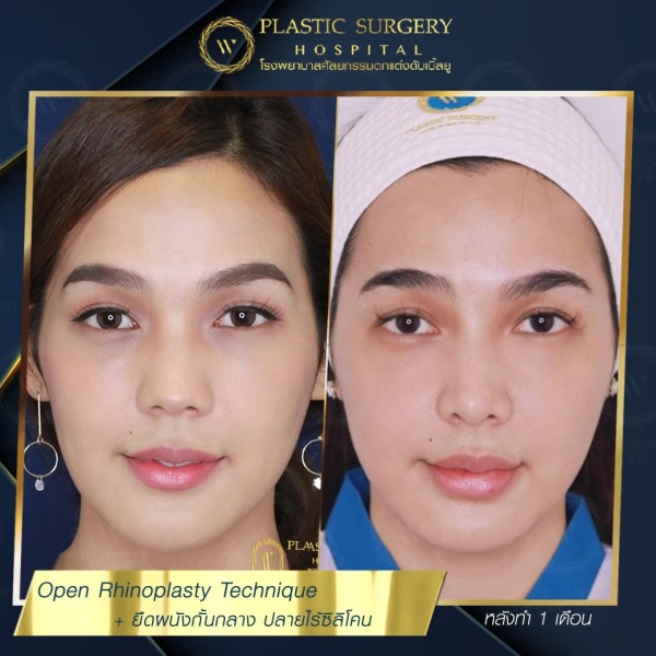 เสริมจมูก