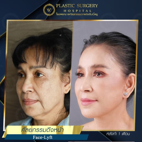 ดึงหน้า