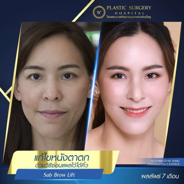 หนังตา/หางตาบนตก