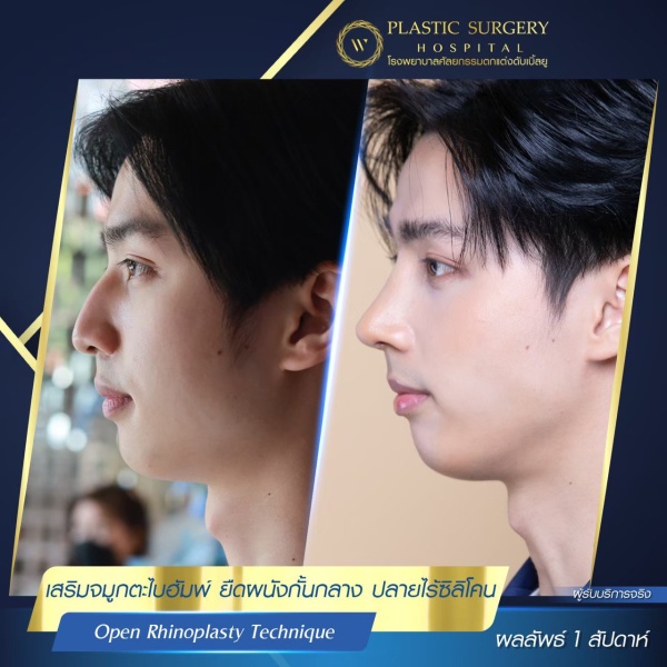 เสริมจมูก