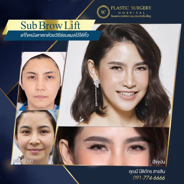 หนังตา/หางตาบนตก