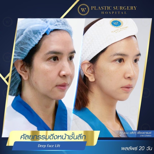 ดึงหน้า