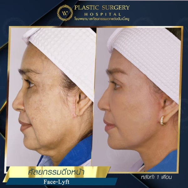 ดึงหน้า