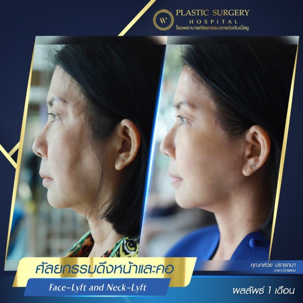 ดึงหน้า