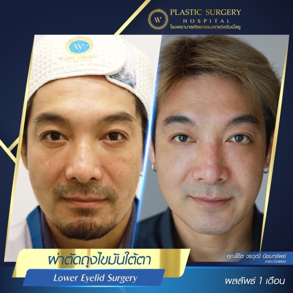 Lower Eyelid Surgery