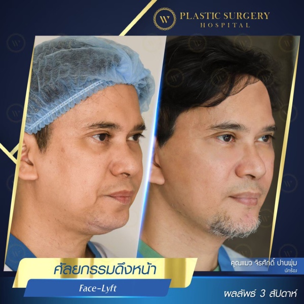 ดึงหน้า